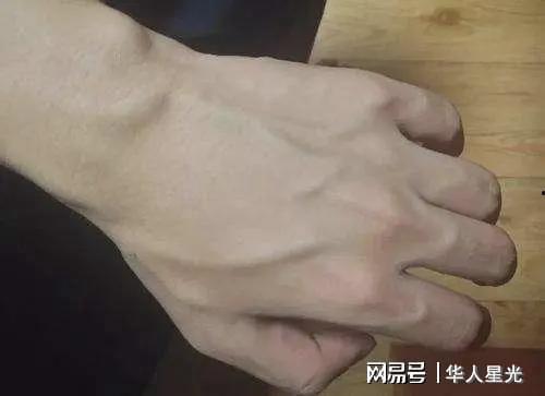 暴青筋图片,探寻血管爆裂背后的惊人真相
